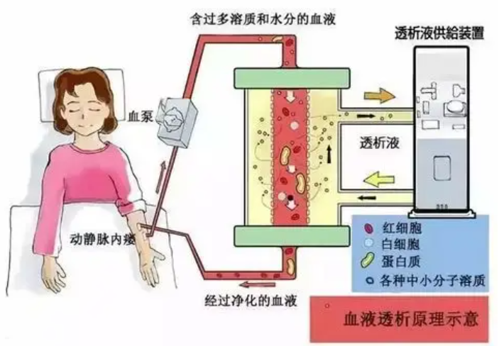 睡着也能透析：揭秘自动化腹膜透析