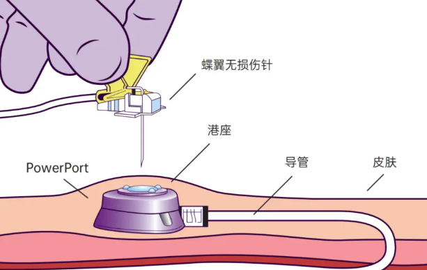 娄底市中心医院2024年健康科普图文类三等奖作品《静脉输液港》