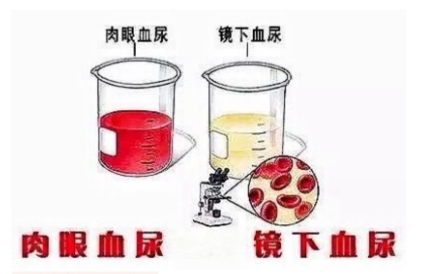 红色尿与血尿，是怎么回事？