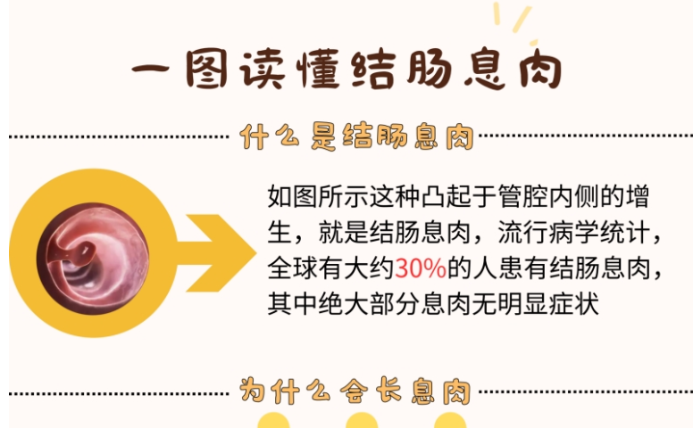 一图读懂结肠息肉