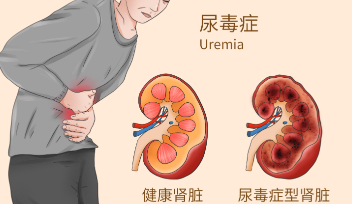 隐形的杀手——尿毒症
