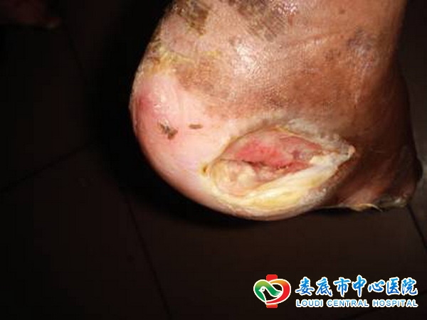 糖尿病患者怎样做好足部护理？