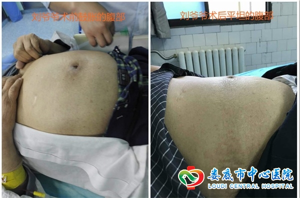 肠内支架，撑开生命的通道