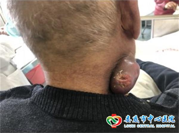 六旬老人枕“鸭蛋”难入眠放疗技术“吃”肿瘤显神奇