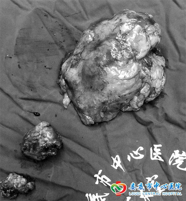 血管“裸化”技术让肾癌患者“死里逃生”