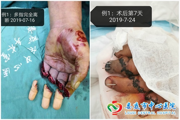 断指方寸“做道场”妙手再植焕生机