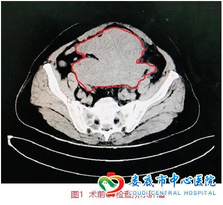 巨型结肠癌肿瘤侵犯内脏专家妙手刀到病除