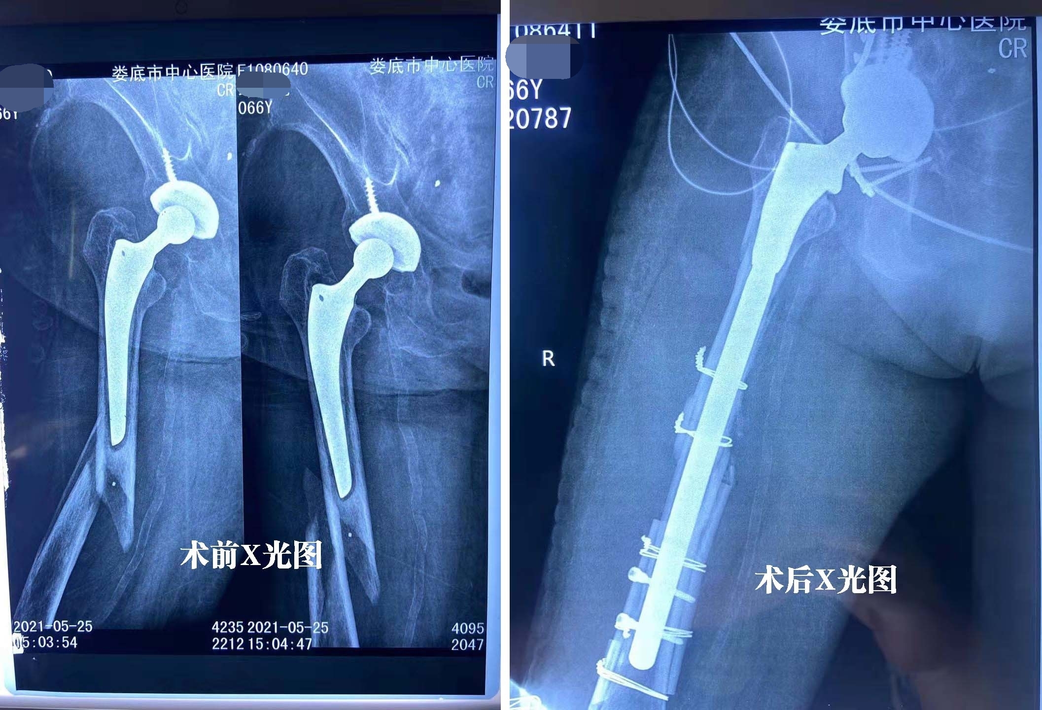 我院成功完成多例高难度髋关节翻修术