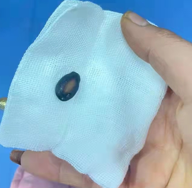 春节期间多名患儿气管异物险丧命专家：小小坚果可能致命，小儿不宜！