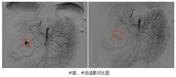 精准介入｜我院成功为多例外伤性动脉出血患者止血
