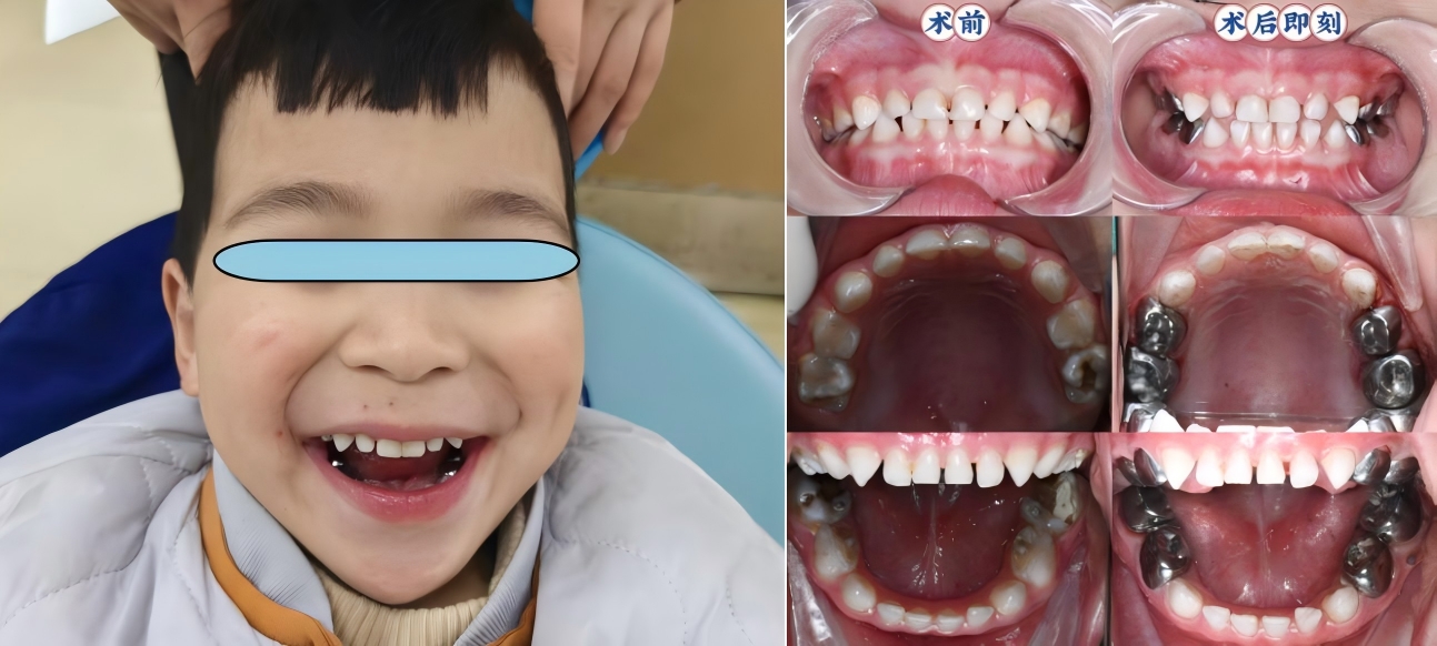 摆脱看牙恐惧！在“睡梦”中告别坏牙